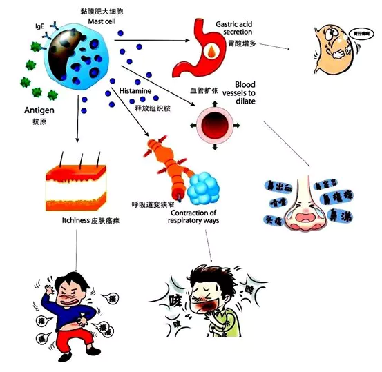 allergic diseases