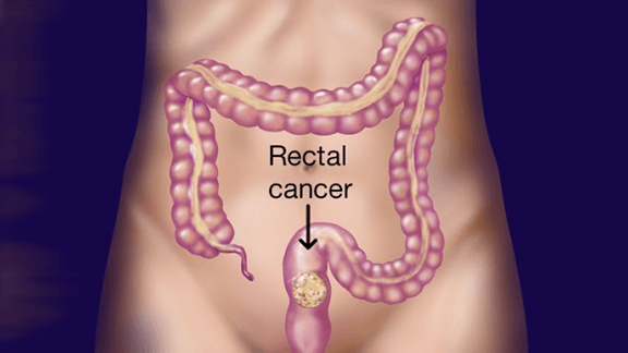 Rectal Cancer Early Screening Kit