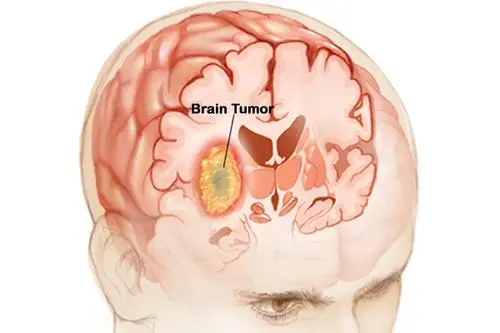 Driver of Deadly Brain Cancer Discovered, Potential New Drug Target