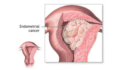 Scientists Double Number of Known Genetic Risk Factors for Endometrial Cancer