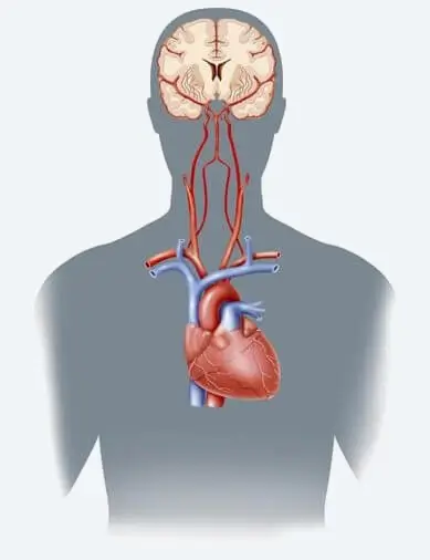 Range of Cerebrovascular Disease.webp