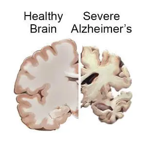 Can Marijuana Protect against Alzheimer