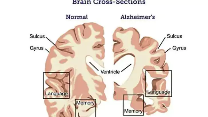 Alzheimer Disease.webp