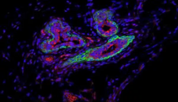 RNA Molecule Shields Breast Cancer Stem Cells from Immune System