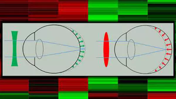 Myopia Comes Into Gene Expression Focus