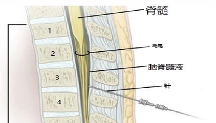 Collection of cerebrospinal fluid via lumbar puncture.webp