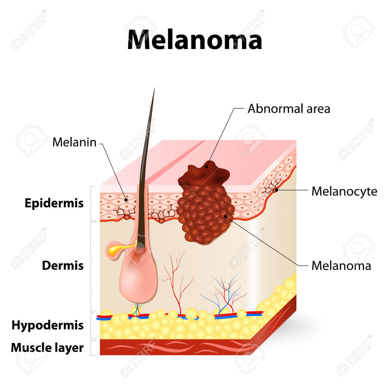 TERT Inhibitors Show Potential in Treatment of Uncommon Type of Melanoma