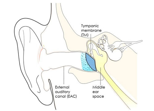 One-Dose Cure for Ear Infections