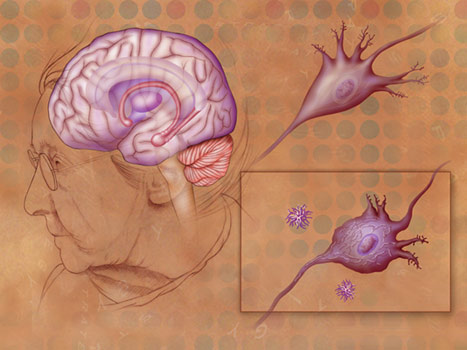 Neurodegenerative Disease Associated with New Gene Variant