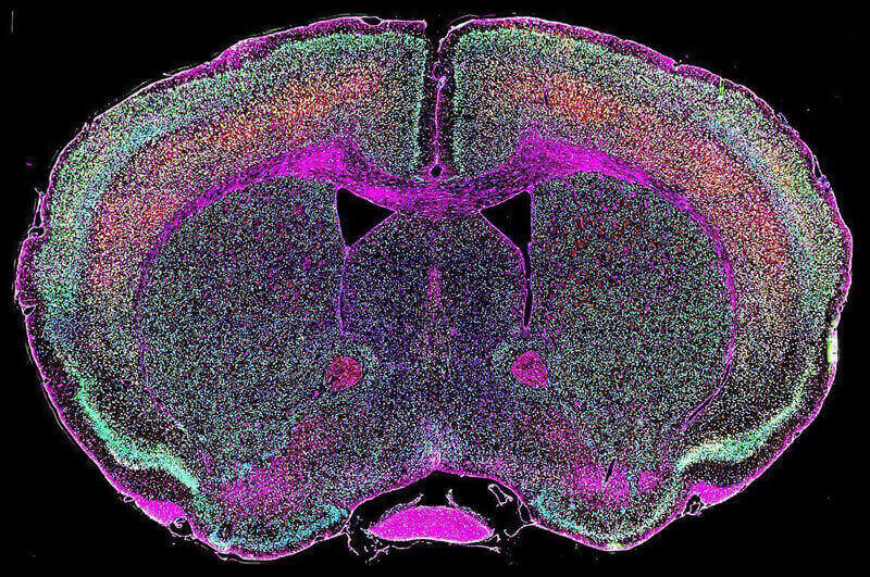 New ALS Gene Variant Identified