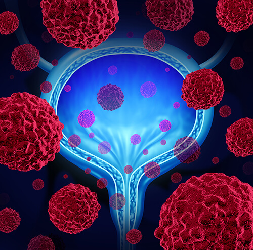 Immune Cells the Missing Ingredient in New Bladder Cancer Treatment