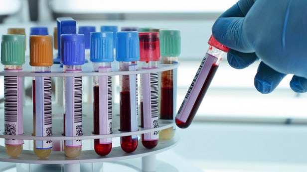 Blood/Urine Biomarker Tests Developed for Autism Spectrum Disorders