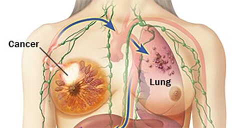 Drug Prevents Cancer by Targeting Both Tumor Cells and the Tumor Microenvironment