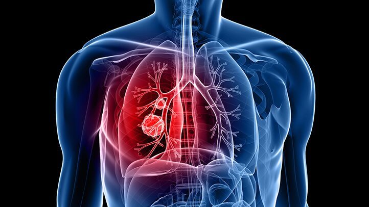 Lung Cancer Biomarker Discovery Raises Hopes for Early Detection