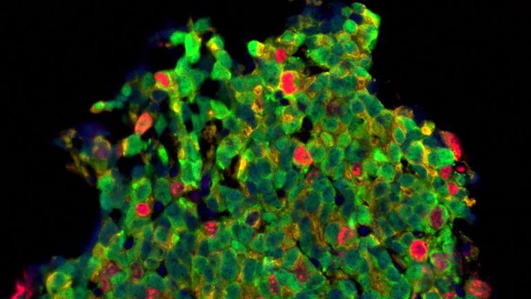 Prostate Cancer Treatment Response Activated by Skin Disease Immunotherapy