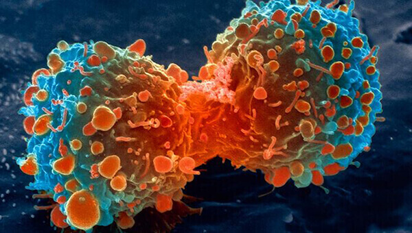 Computing Method Used to Track Cancer Spread