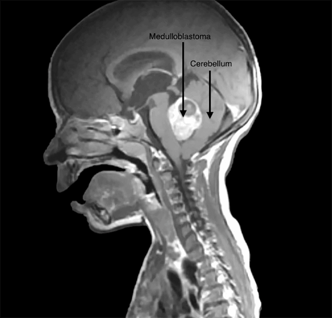 Stems Cells Used as Delivery Truck for Brain Cancer Drugs