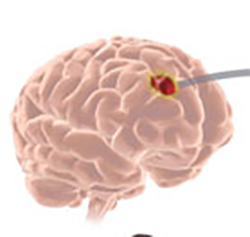 Protein Regulator of Glioblastoma Migration Identified