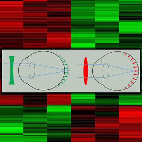 Myopia Gene Expression